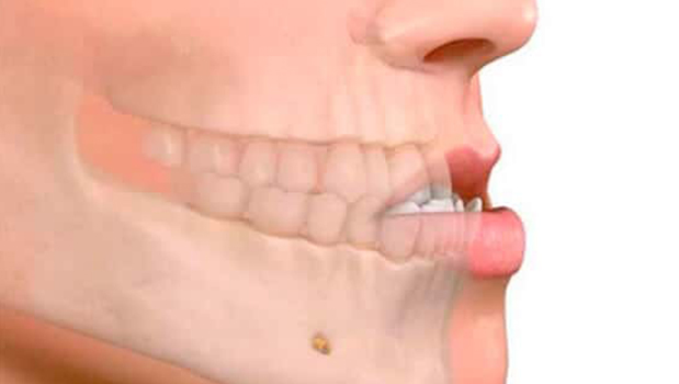 Sensibilidad dental