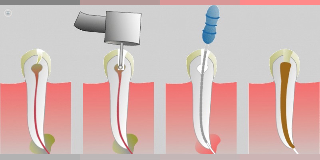 Endodoncia empaste fluoración