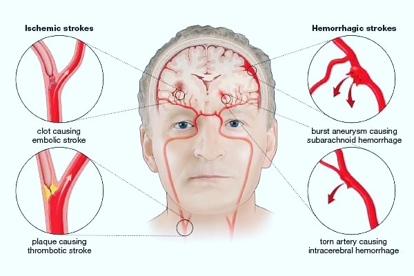 ¿ Podríamos hacer tratamiento masage tailandés con "parálisis y paraplejía “ ?