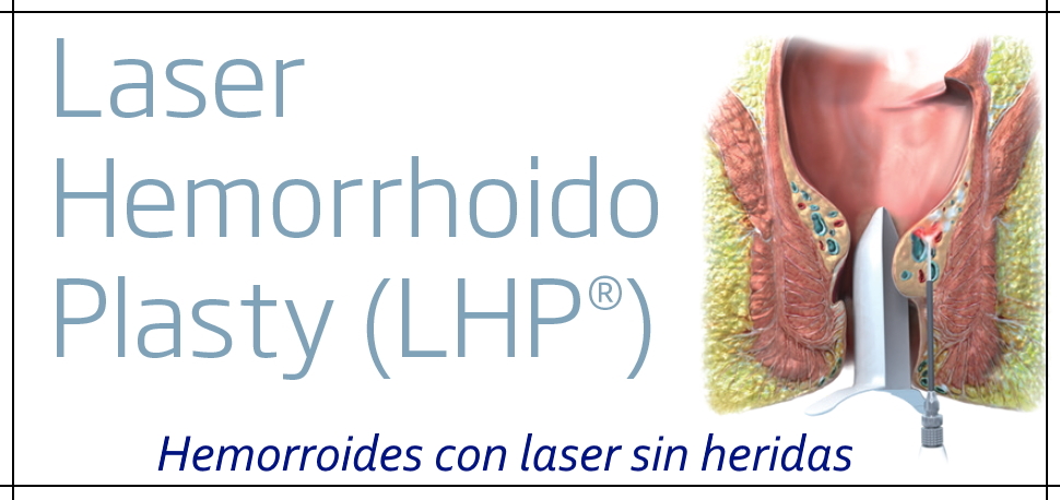 Hemorroides con laser