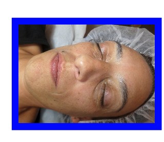 acupuntura facial con paciente