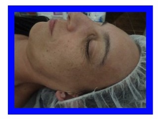 acupuntura facial con paciente