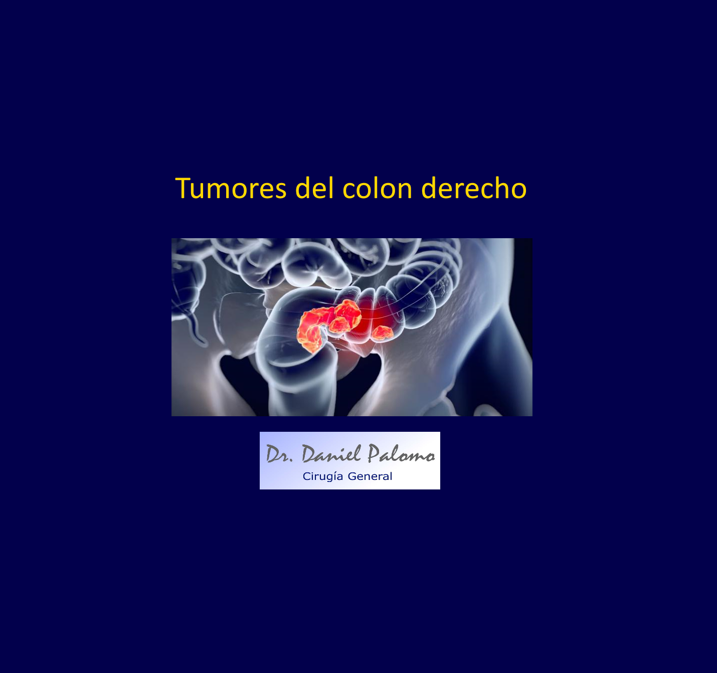 Tumores del colon derecho