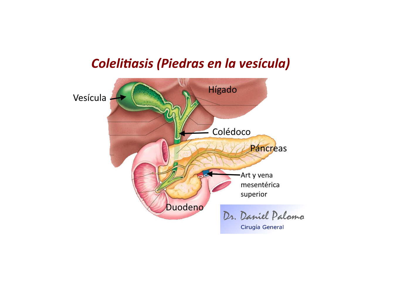 Patología vesicular: Colelitiasis