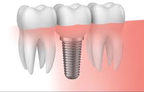 implantes dental Barcelona